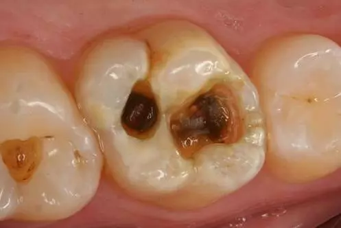 牙齿上的"小黑线"到底是什么?蛀牙还是沉淀?