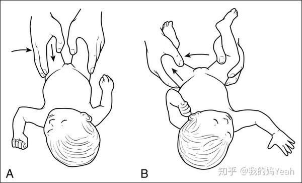 怀疑宝宝是ddh(发育性髋关节脱位),我们做了两次检查