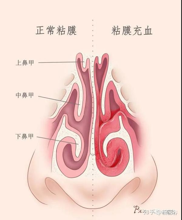 鼻腔堵塞;而由于交替改变,原来充血的鼻甲恢复正常,阻力减小,鼻腔通畅