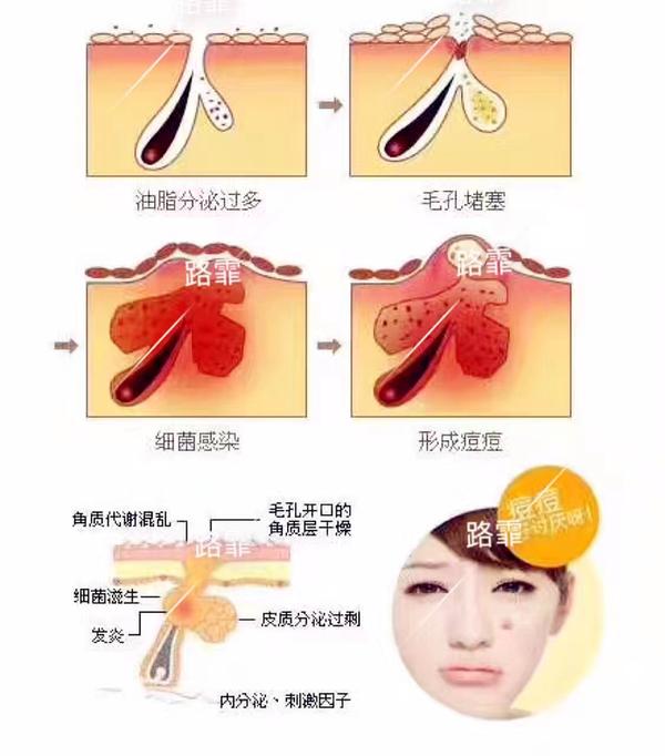 只要毛孔内的脂栓(也就是痘根)一直没有清除,痘痘就会反复的长.