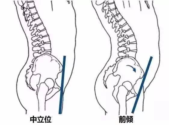 首先对于腰椎曲度改变出现腰痛的人来说: 长期驼背,久坐等不良习惯会