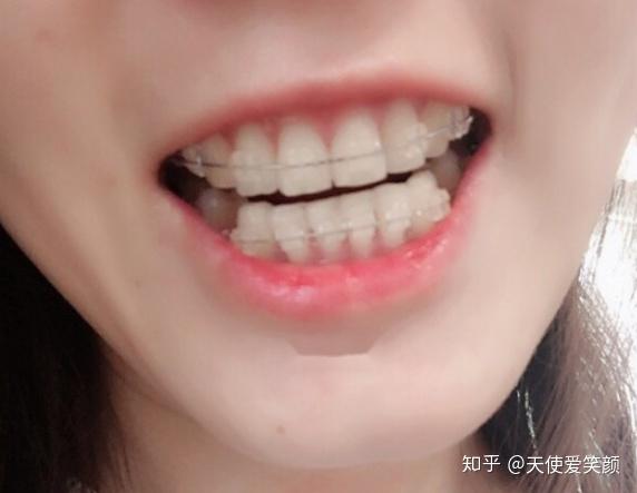 北京上海牙齿矫正多少钱陶瓷牙套矫正10个月啦