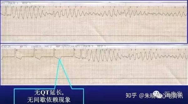 尖端扭转室速