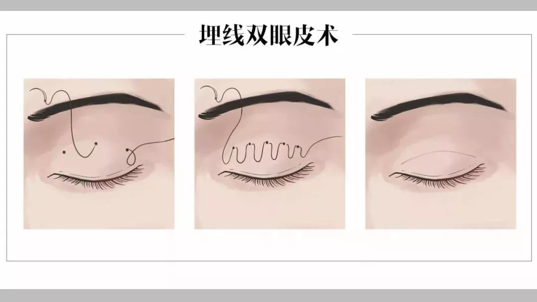埋线双眼皮怎么做如何正确修复
