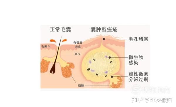 第六类是由丘疹型痤疮发展而成的脓包型痘痘,这类型要注重调节水油