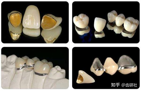 全瓷冠和烤瓷冠的区别看了就能做出选择