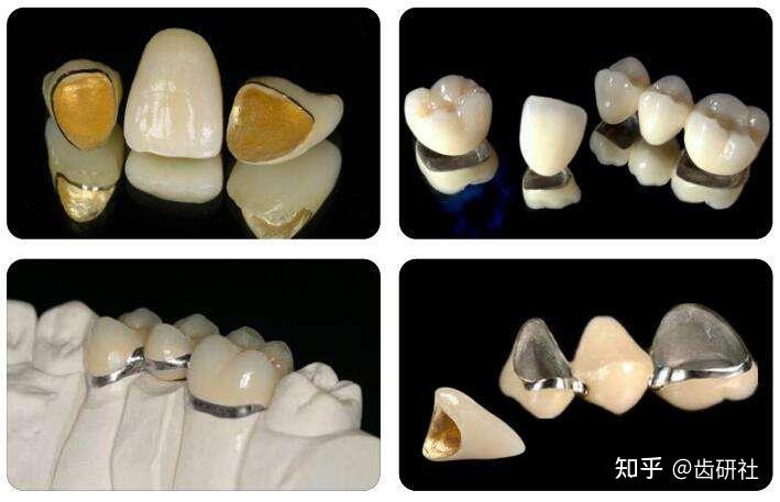 烤瓷冠也叫烤瓷牙:是由内部的金属基底层和外部的瓷层两部分构成,拥有