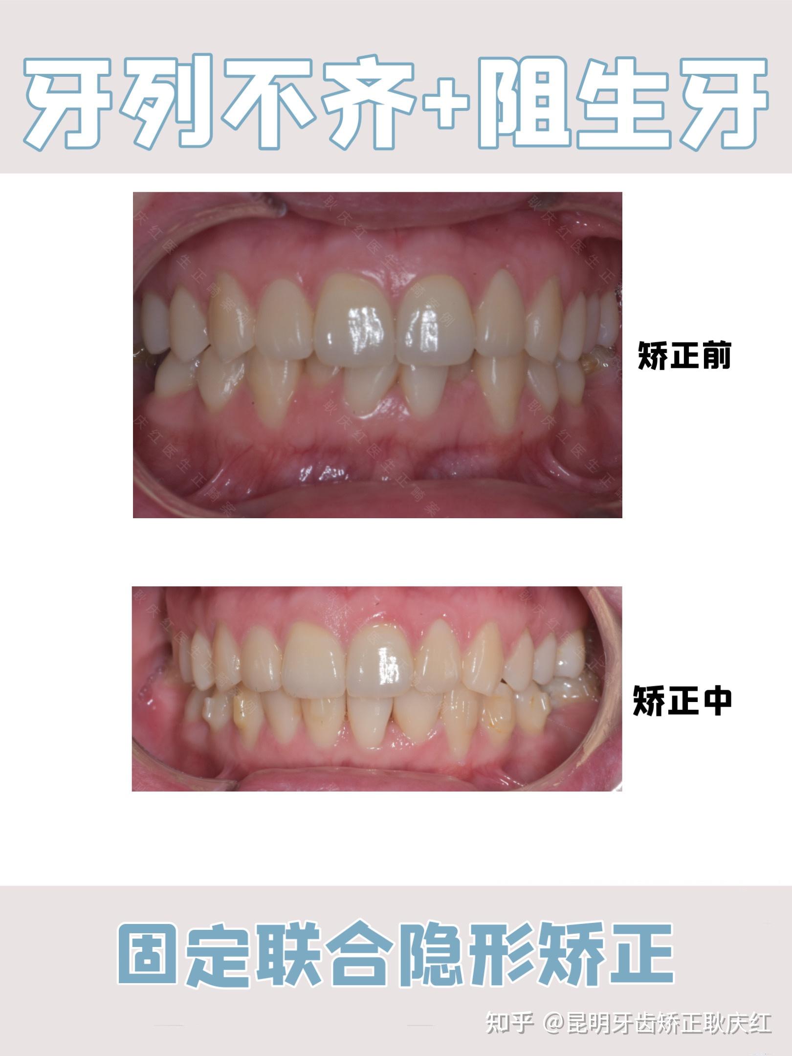 昆明牙齿矫正昆明正畸固定金属矫治器vs隐形矫正器隐适美