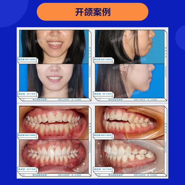 牙齿开颌可以通过正畸改善吗?