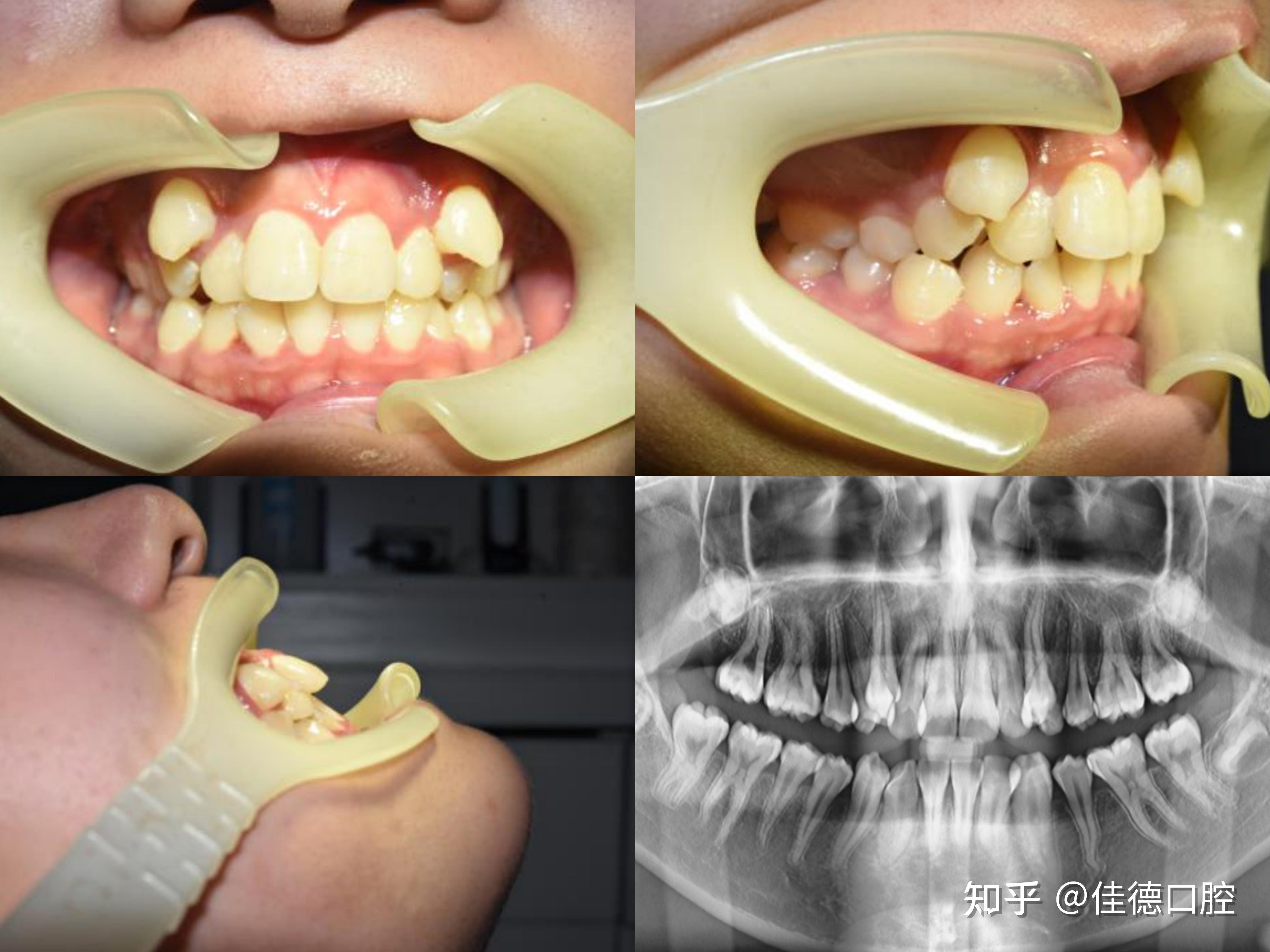 合肥矫正牙齿的好医院牙齿拥挤不齐虎牙位置高矫正案例