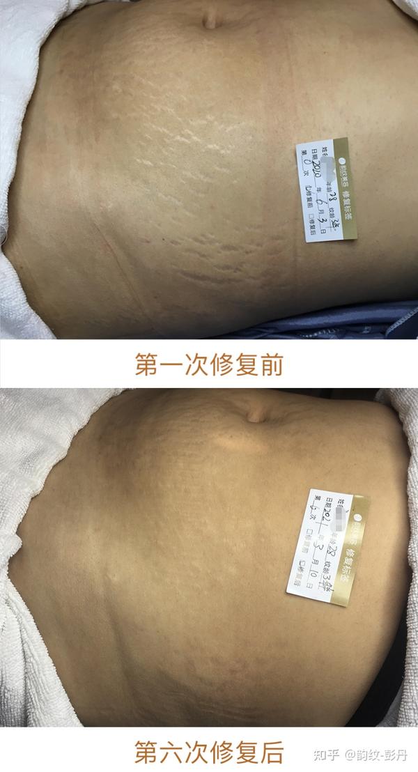 外涂修复品这些是无法去除妊娠纹的,橄榄油,身体乳这些是起一个保湿
