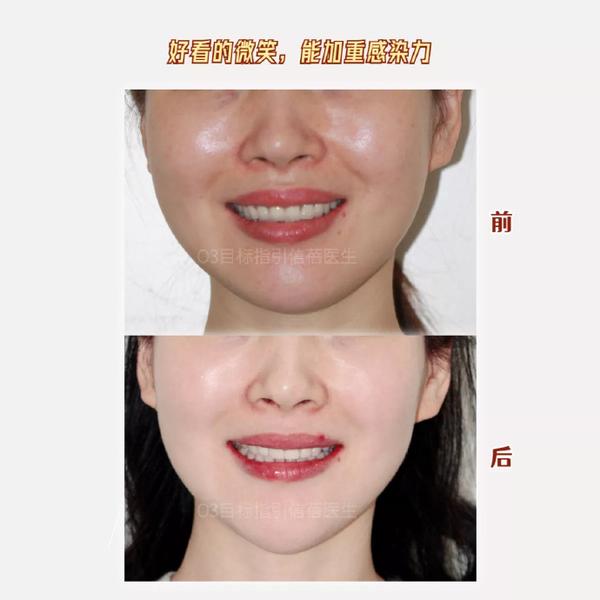 深圳牙齿矫正为什么正畸要注重微笑因为能够加重感染力