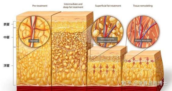 可能会碰到 血管,我们的脂肪分为三个层次,皮下脂肪分布着交错复杂的