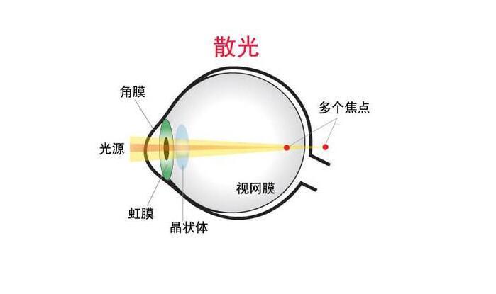 在疫情期间为什么你的眼睛散光,近视的度数加深了?
