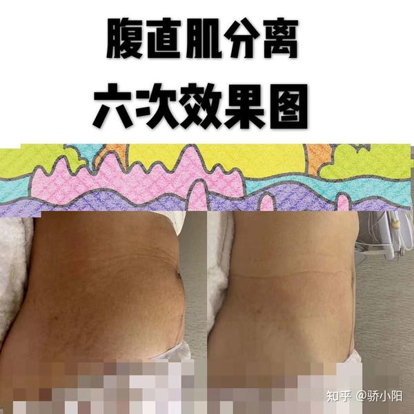 生完宝宝肚子里还有一个?产后大肚子,肚皮松垮瘦不回去,多半是因为它!