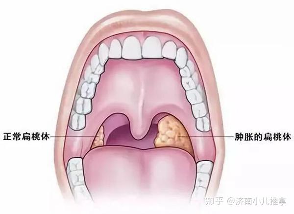 (如果扁桃体肥大2度以上,影响正常呼吸时,要及时找医生面诊进行评估