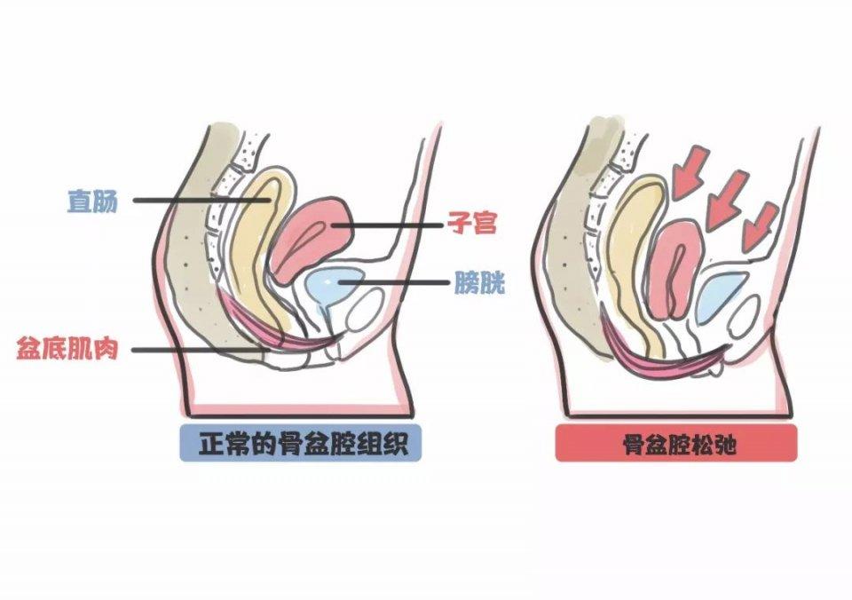 女性的盆底是什么?