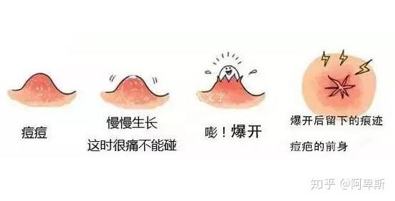 控制痘痘的生长?