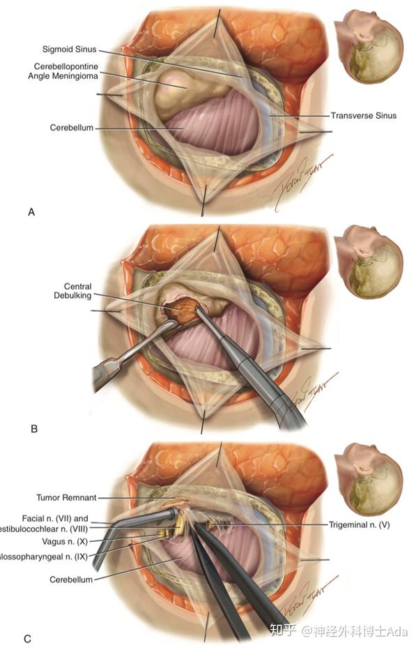脑瘤开颅手术入路解读:标准乙状窦后入路vs扩大乙状窦