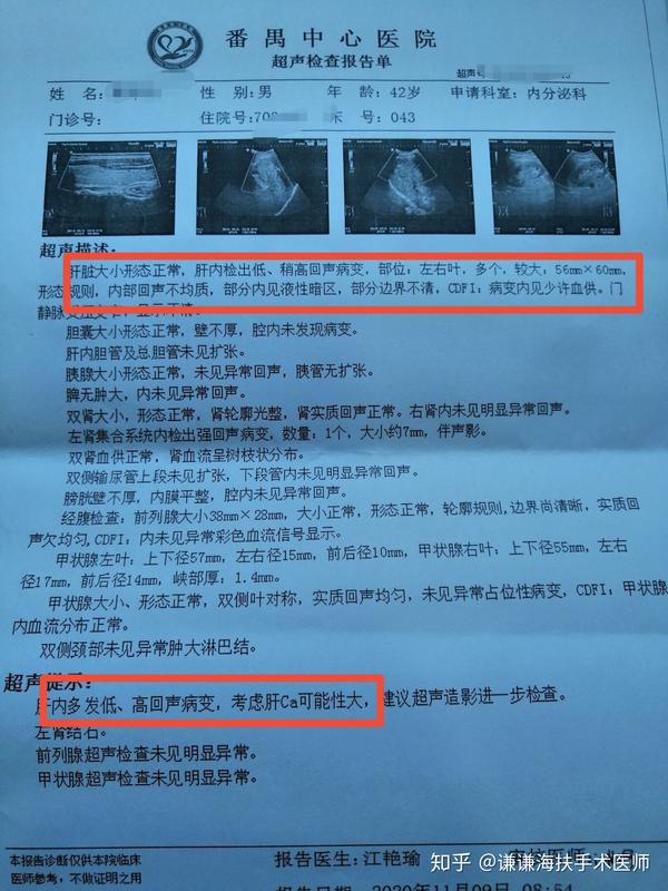 巨块型原发性肝癌病例分享