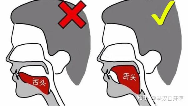 如何判断是不是口呼吸?