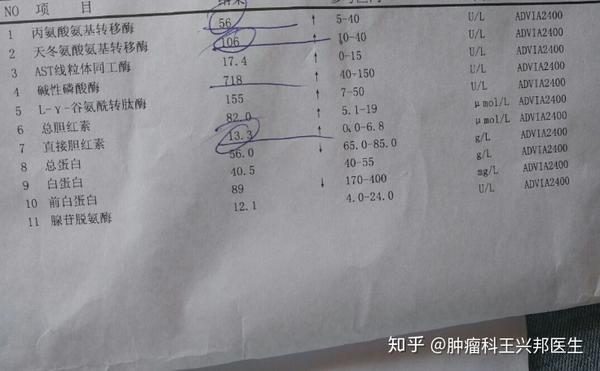 三大危险信号需警惕胰腺癌