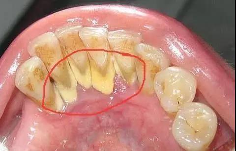 设计师 牙结石从牙冠逐渐向下蔓延,牙结石每进步一些,牙槽骨就萎缩