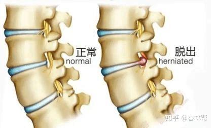 腰椎间盘突出症阶梯治疗脊柱外科专家隰建成科普系列