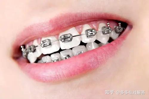 北京牙齿矫正丨金属牙套篇,想在北京做金属牙套矫正的朋友可以看看呢
