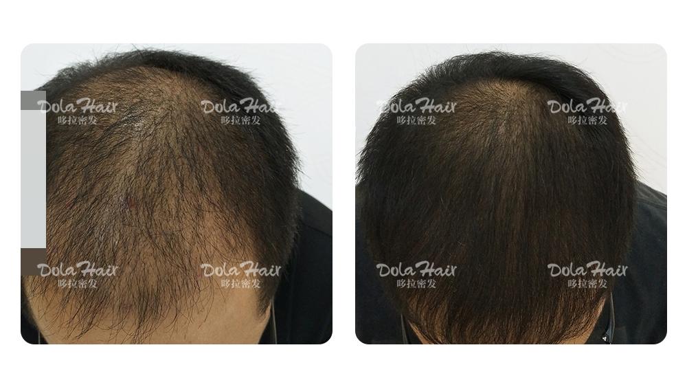 用浓度更高的米诺地尔,是不是效果直接翻倍?