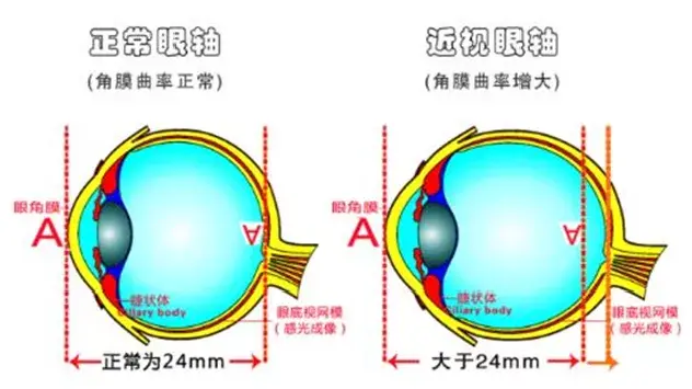 高度近视并发白内障和青光眼的机会也比正常人高