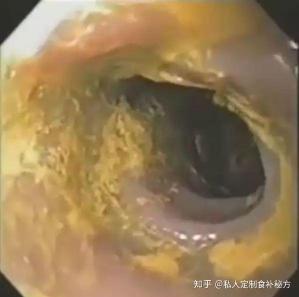 便秘.排便黑,硬,呈颗粒状,排便困难,排便时肛门出血