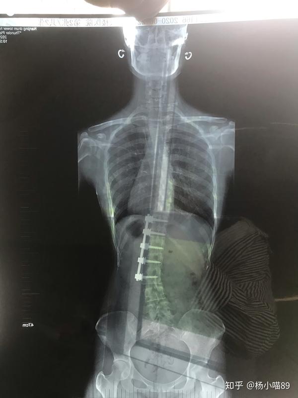 有没有同脊柱侧弯术后病友