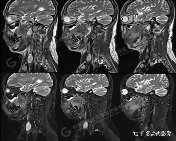 【西安高尚医学影像诊断中心病例】口腔鳞状细胞癌2例