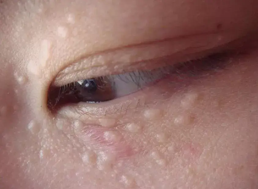 汗管瘤扁平疣不小心絮絮叨叨好多,关于眼周的问题还有很多,黑眼圈