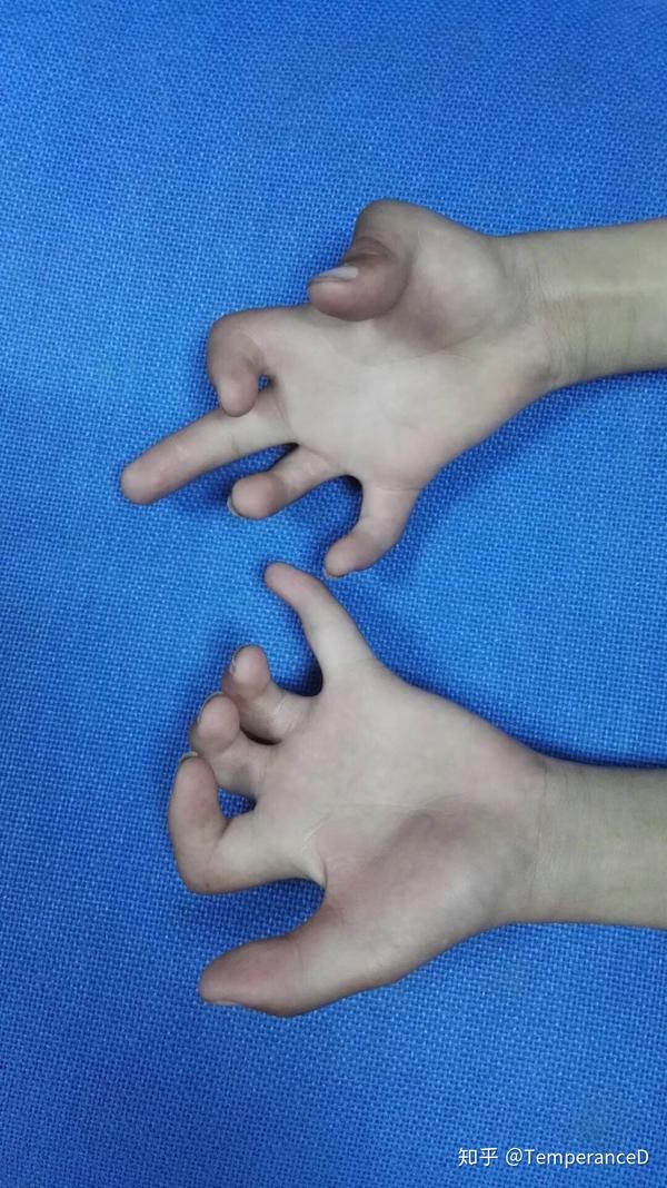 由于父母近亲结婚,他与两个亲哥哥都患有双手多关节挛缩症,表现为手指