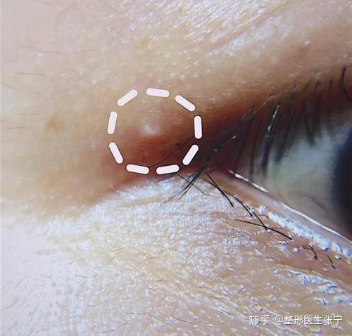 眼皮上有脂肪粒会影响割双眼皮吗