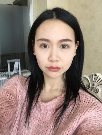 肋软骨鼻综合整形手术前后对比效果图片和恢复过程