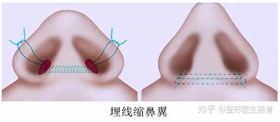 还有一种埋线缩鼻翼的方法,就是用缝线的方法把两侧鼻翼基底部缝合缩