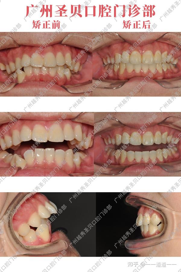 广州圣贝牙齿矫正案例分享:牙齿不齐 前牙深覆盖治疗