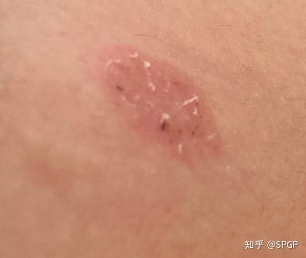 干货分享|被传染猫藓后,我的用药经历