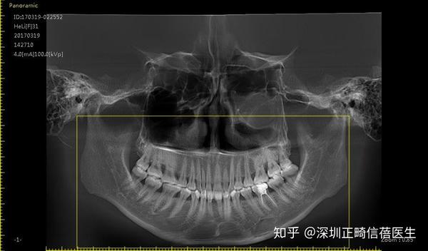深圳牙齿矫正:骨性前突隐适美正畸案例