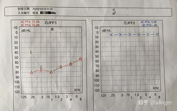 16号门诊开药那天的听力报告(ac平均下降70分贝左右)