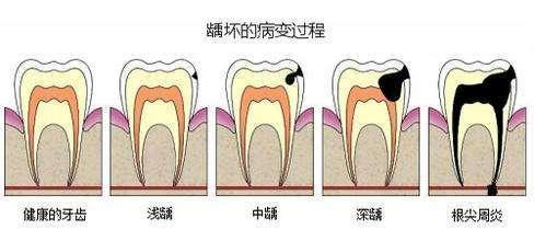牙齿变黑成蛀牙,不疼就不用管吗?小心拖到后期不但费时还费钱
