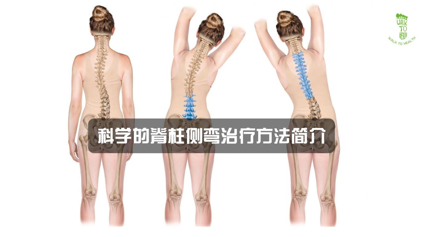 科学的脊柱侧弯治疗方法简介