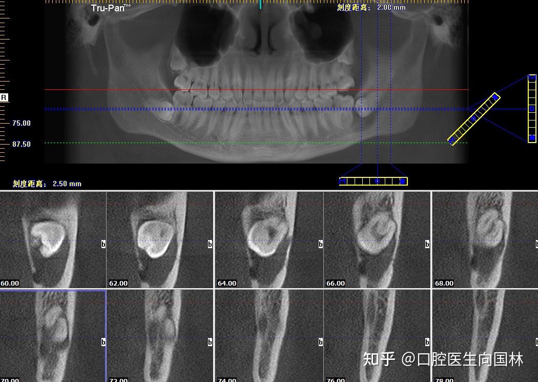 28.38.48埋伏阻生,38牙冠下见约2.2*1.