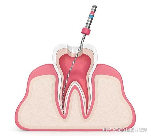 什么是根管治疗 根管治疗术是针对牙齿,牙髓,根尖病变的一个治疗过程.