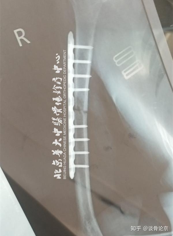 肱骨骨折5个月未愈合患者28天治疗效果骨折延迟愈合治疗案例