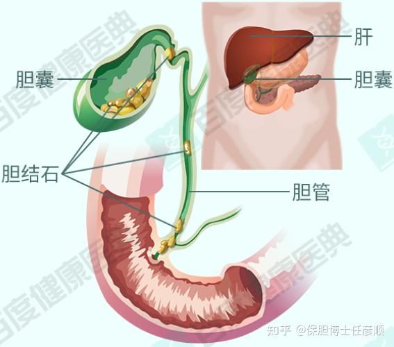 胆结石都需要做哪些检查?