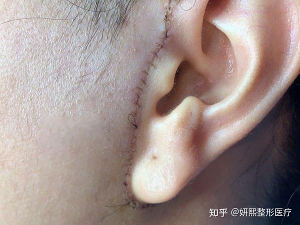 因为耳朵的位置是固定的,中面部除皱如果用小切口的话,多余的皮肤不能